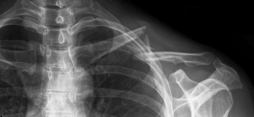 collarbone break