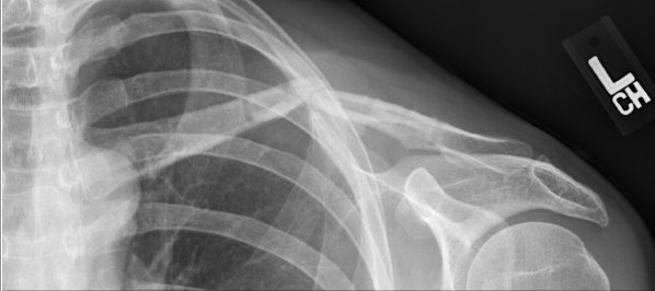 collarbone after plate removal